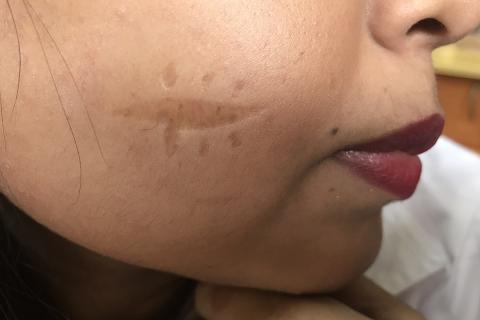 Scars on her cheek. The Thai for "scars on her cheek" is "แผลเป็นบนแก้มของเธอ". Scars on her cheek. The Thai for "scars on her cheek" is "แผลเป็นบนแก้มของเธอ".